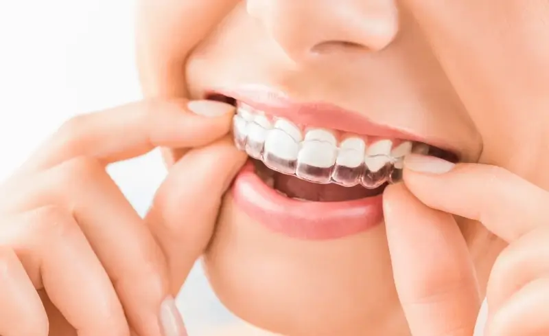 Dlaczego warto wybrać leczenie Invisalign?