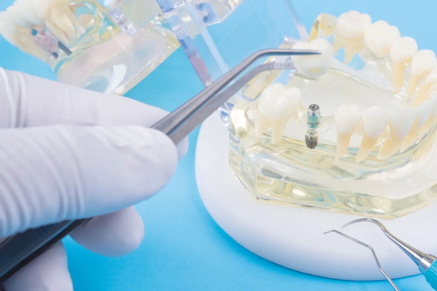 Implanty gdzie najtaniej?