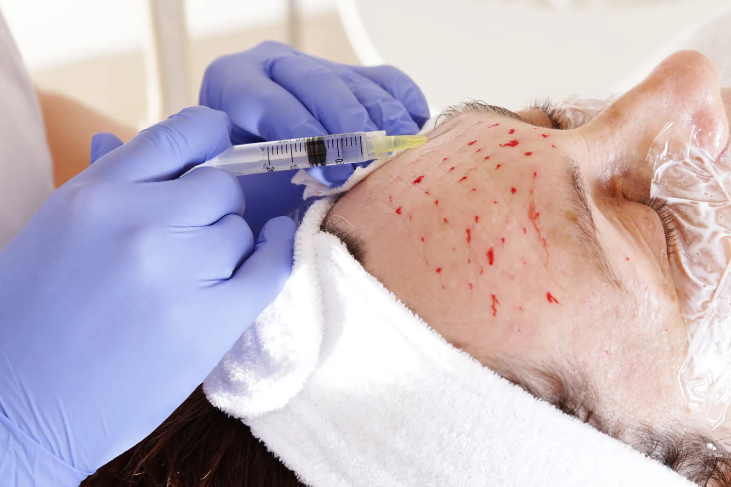 Co lepsze botoks czy kwas hialuronowy?