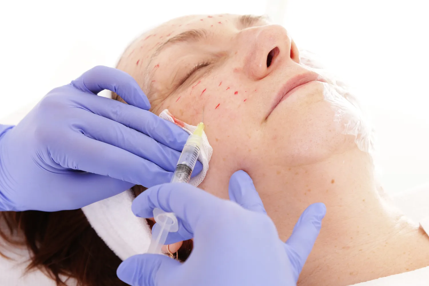 Co to jest kwas hialuronowy?