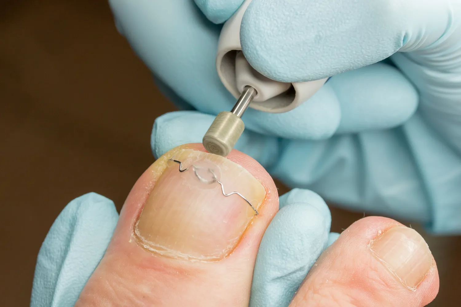 Jaka myjka ultradźwiękowa w gabinecie podologicznym?