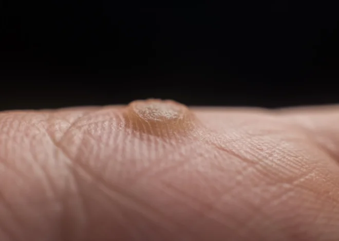 Co zrobić na kurzajki?