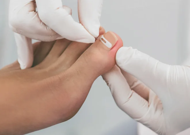 Dobry podolog radzi – wrastanie paznokcia