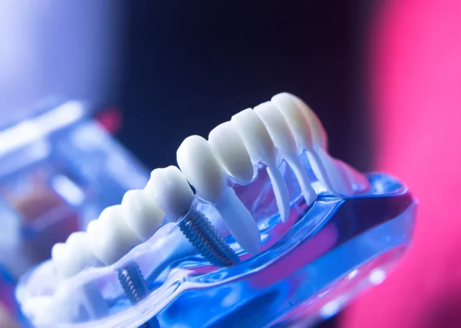 Implanty Czechy czy warto?