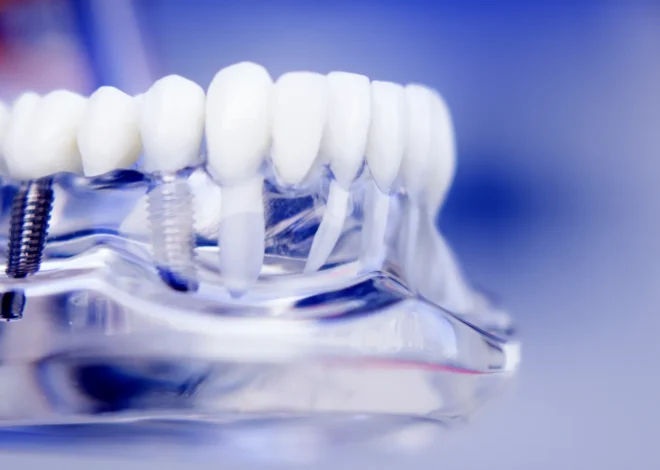 Implanty dentystyczne – czy mogą zastąpić prawdziwe zęby?