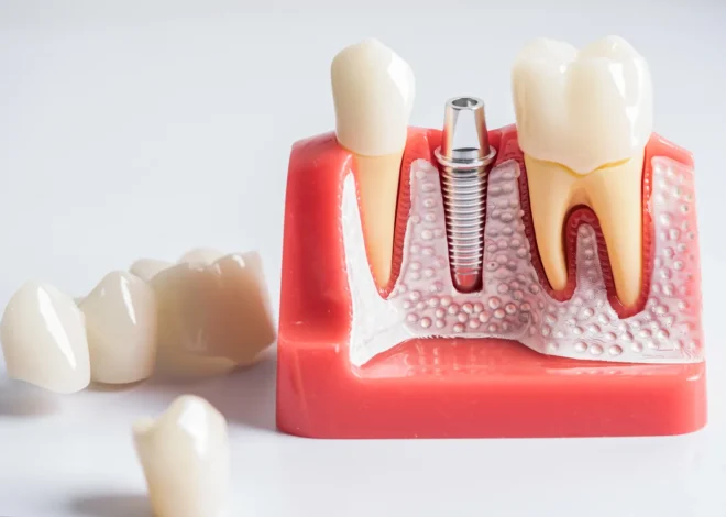 Implanty w jeden dzień Szczecin