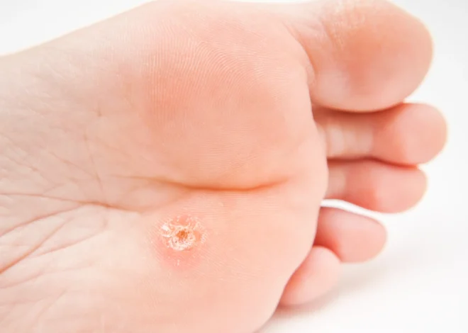 Podolog usuwanie kurzajek