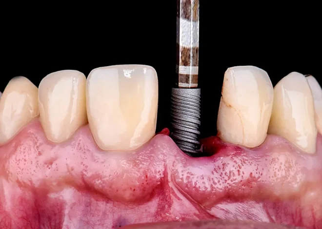 Zęby w jeden dzień Szczecin