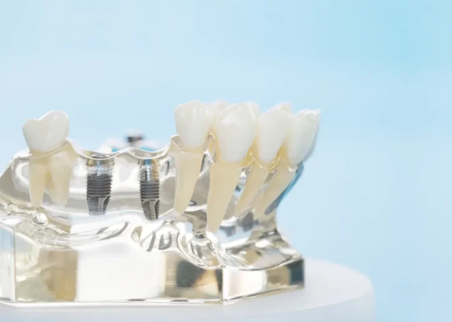 Implanty zębowe Warszawa