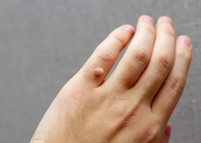 Jaskółcze ziele na kurzajki jak stosować?