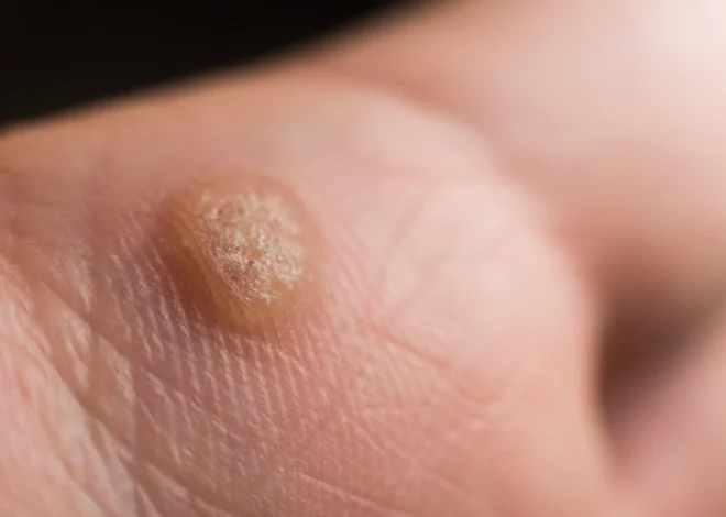 Skąd biorą się kurzajki?